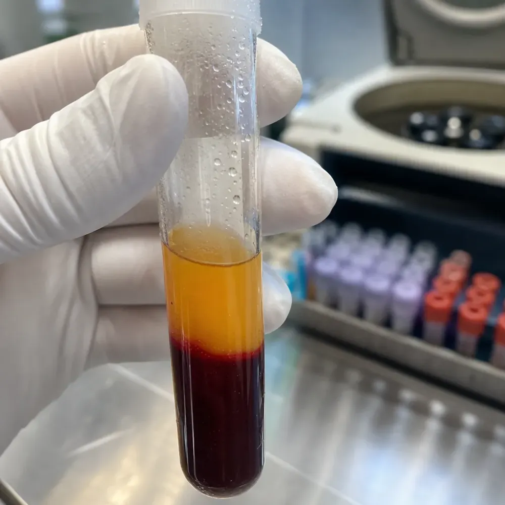 Close-up of PRF tube showing fibrin separation at Be Still Southside in Jacksonville